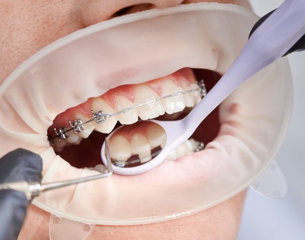 Dentist attaching metal braces to patient teeth. Close up of orthodontist placing orthodontic brackets on patient teeth. Person with cheek retractor and metal braces on teeth having dental procedure in clinic. Concept of orthodontic treatment.